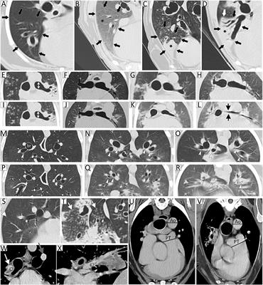 Risk Factors and Outcomes in Dogs With Respiratory Disease Undergoing Diagnostic Airway Lavage